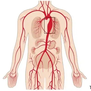 Abdominal Aortic Aneurysm