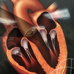 Mitral Valve Disease